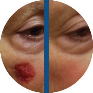 Before and after images of treatment using image guided skin cancer treatment system