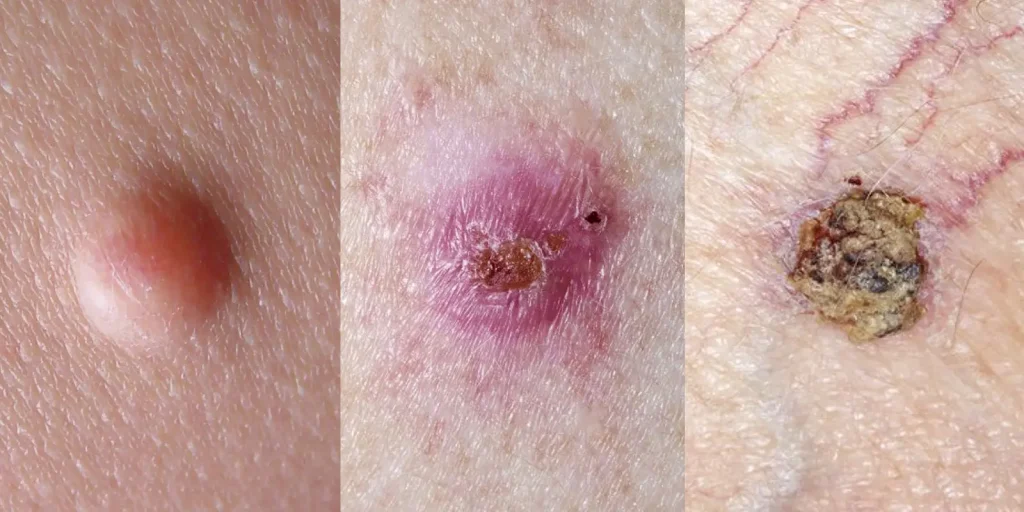 Example of basal cell carcinomas