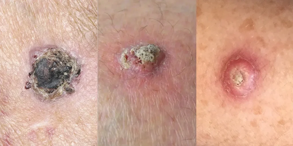 examples of squamous cell carcinomas