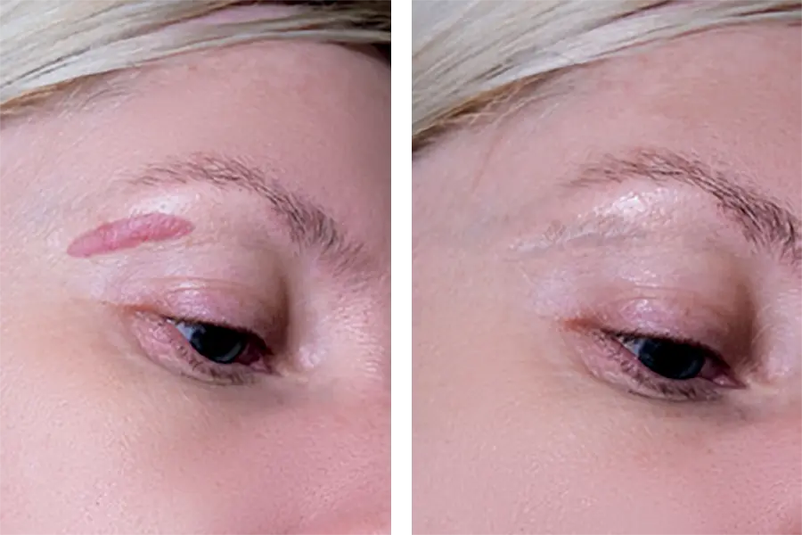 before and after treatment of keloids near woman's eyebrow